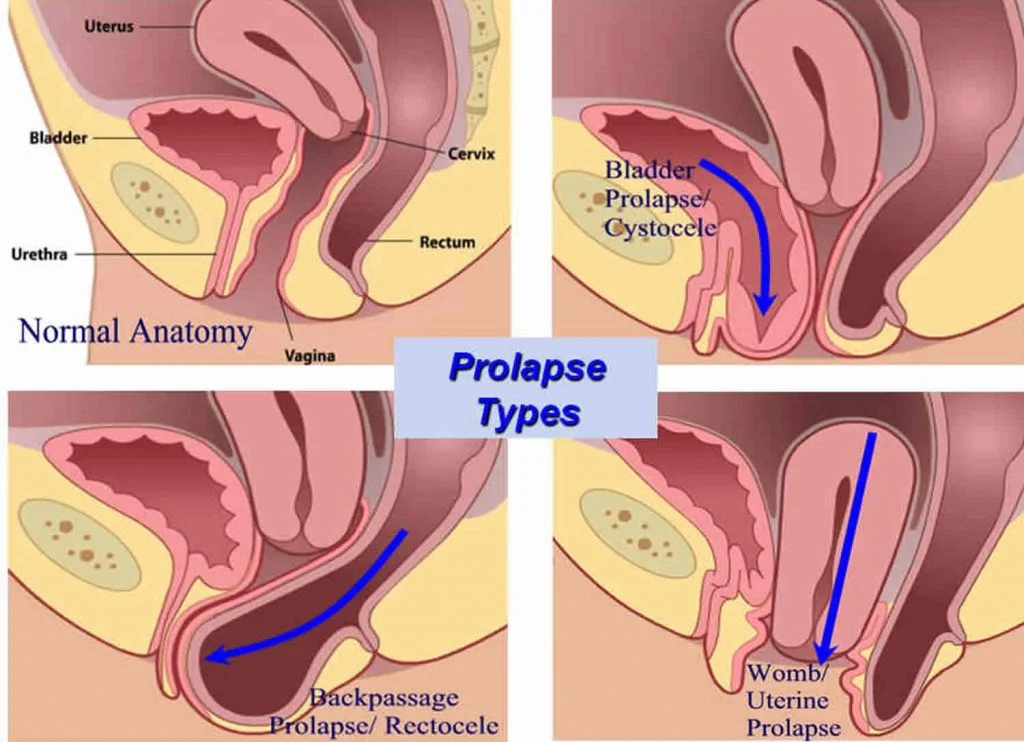 types of pelvic organ prolapse