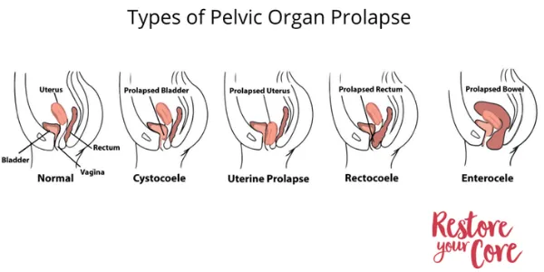 Types of Pelvic Organ Prolapse (left to right): Normal, cystocoele, uterine prolapse, rectocoele, enterocele