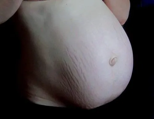 This is what stretch marks look like on a pregnant woman