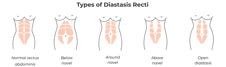 how to fix diastasis recti