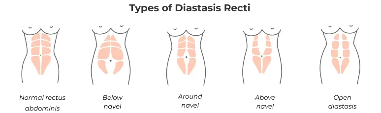 how to fix diastasis recti