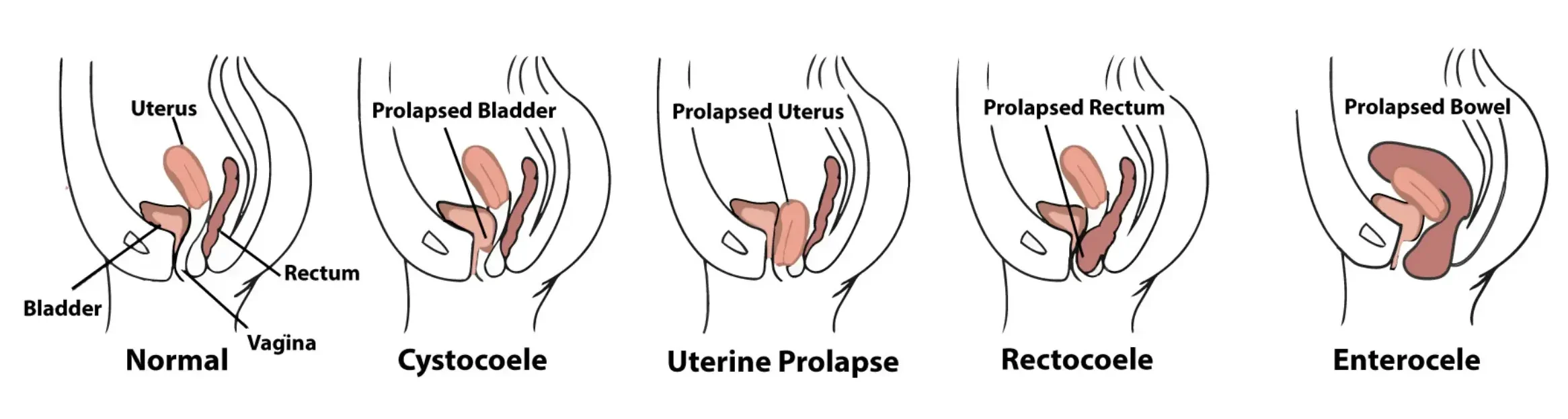 Can Postpartum Prolapse Heal Itself?
