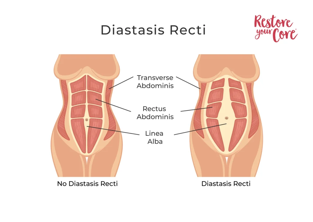 RYC-Diastasis-Recti – RYC®