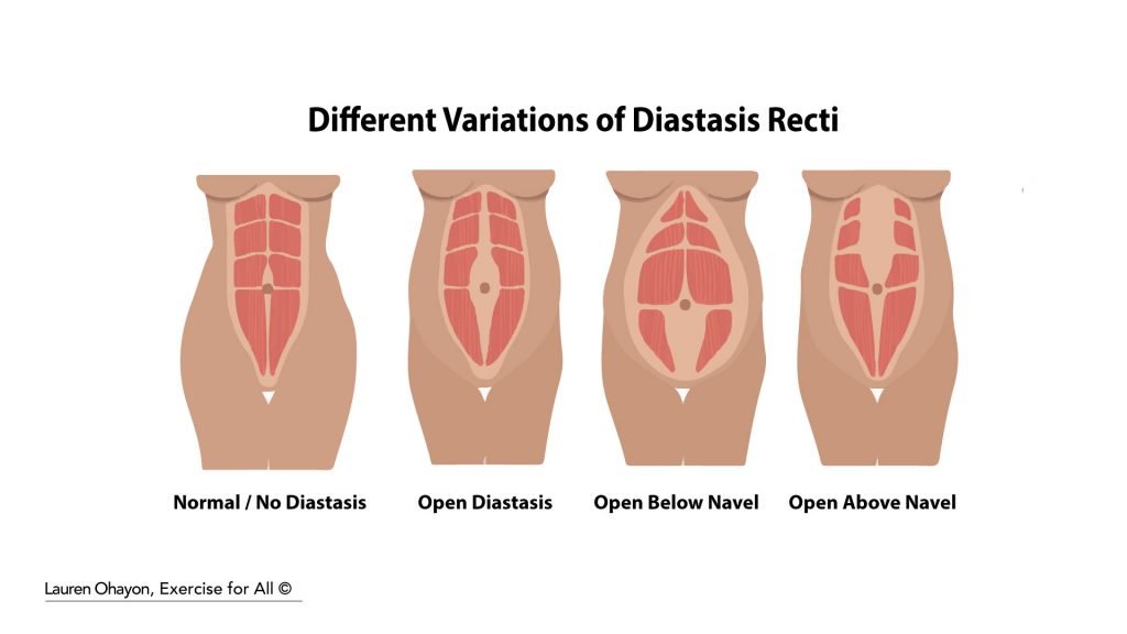 Different variations of Diastasis Recti