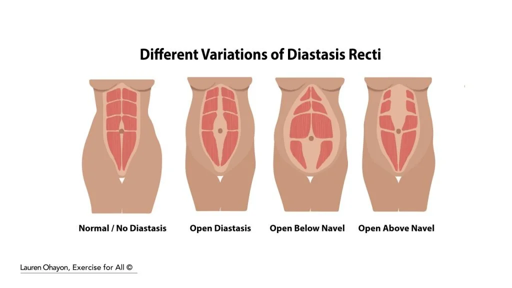 Different variations of Diastasis Recti