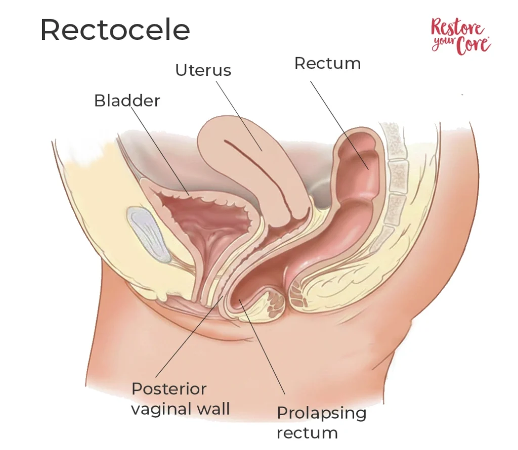 Rectocele – RYC®