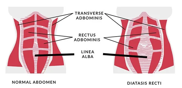 Linea alba in normal abdomen and abdomen with diastasis recti