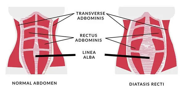 Linea alba in normal abdomen and abdomen with diastasis recti
