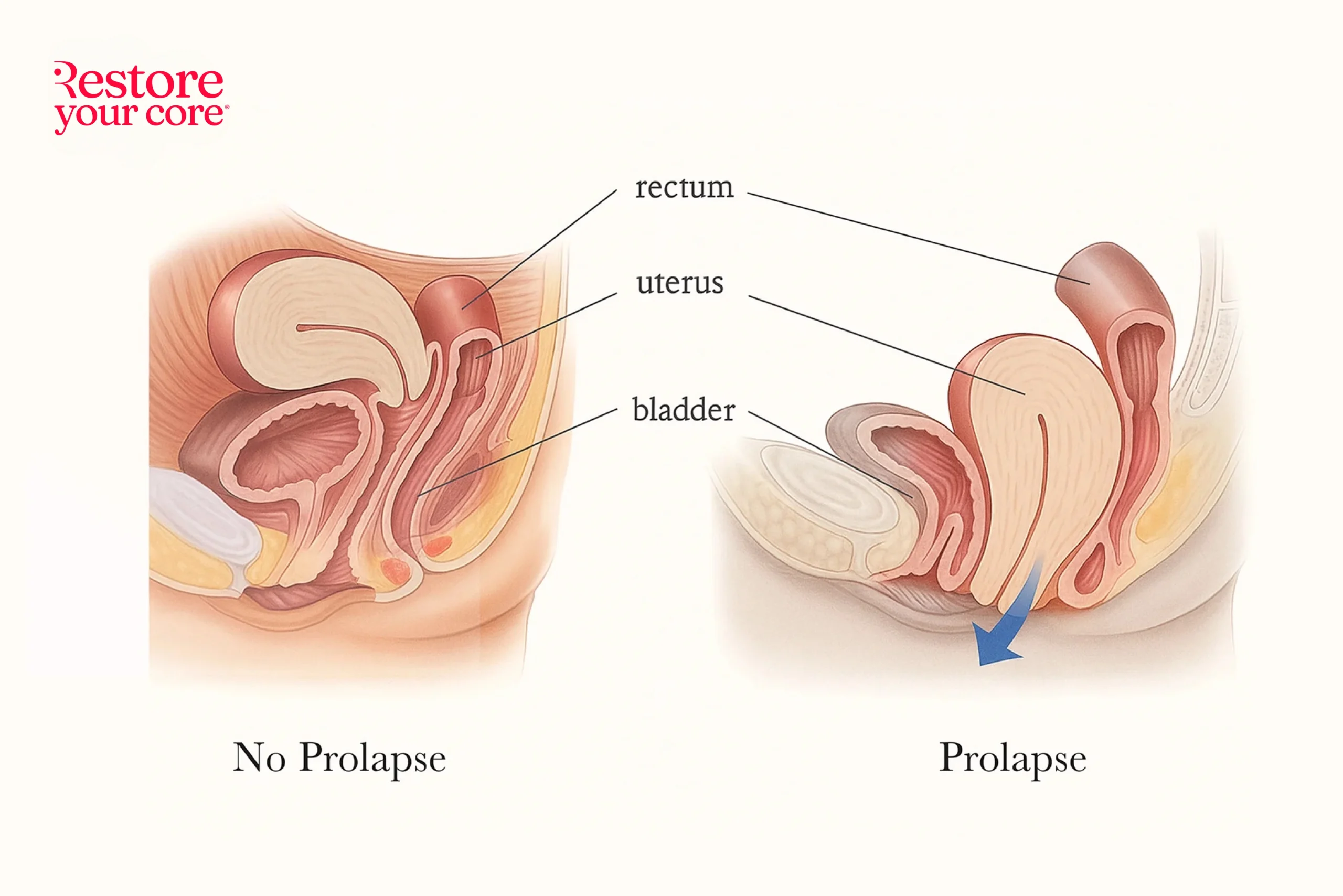 The Postpartum Bulge: Healing Prolapse After Birth With Confidence