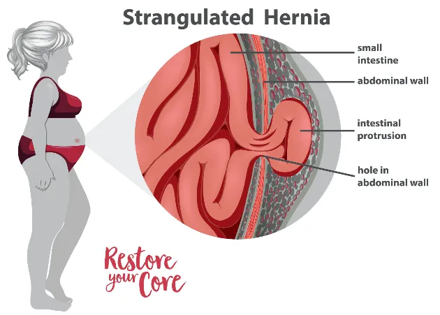 strangulated hernia