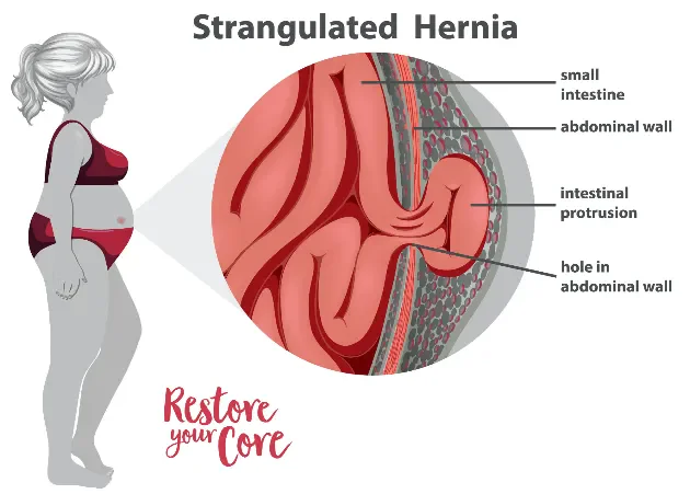 strangulated hernia