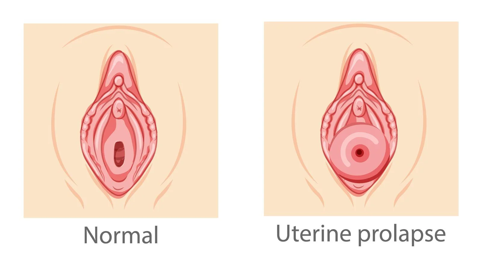 Can You Have Intercourse With Prolapsed Uterus?