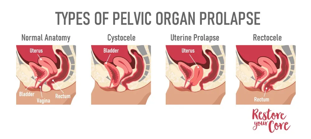 types-of-pelvic-organ-prolapse-1