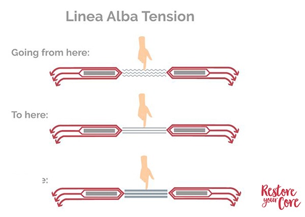 Linea Alba tension