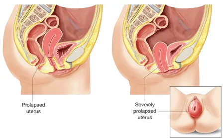 severely prolapsed uterus