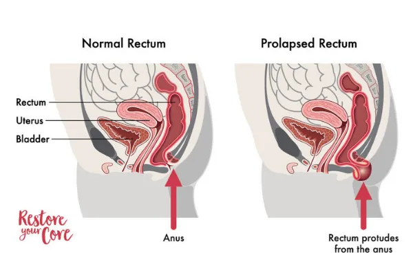what does a rectal prolapse look like