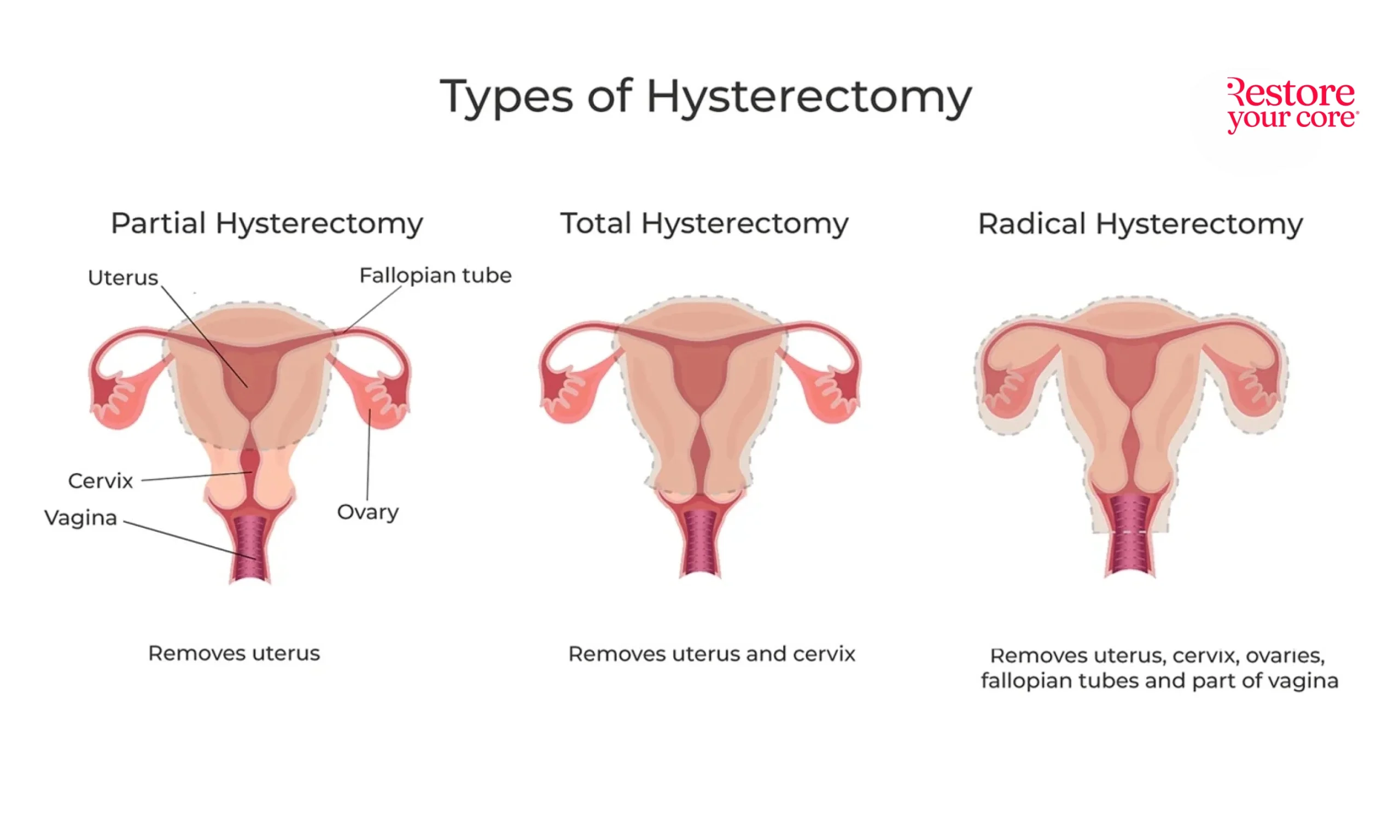 Types-of-Hysterectomy RYC®