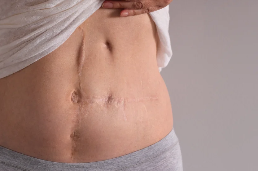 Prolapse After Hysterectomy: A Comprehensive Guide to Risks and Prevention
