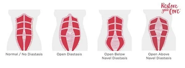 variation of diastasis recti