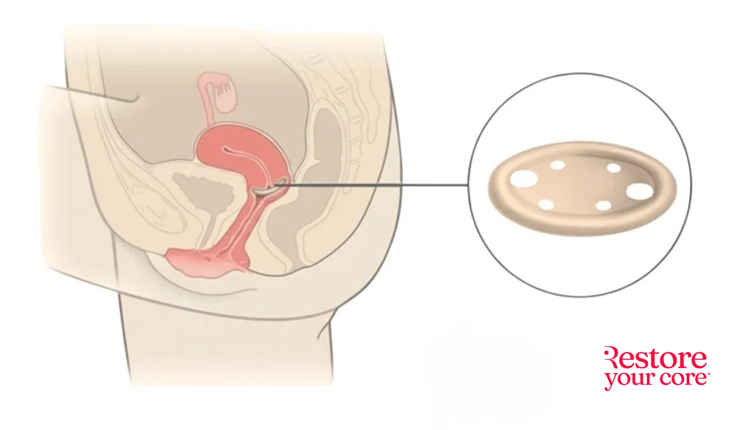 Should I Use a Pessary for Prolapse? The Ultimate Guide to Uses, Types, Placement, and Care