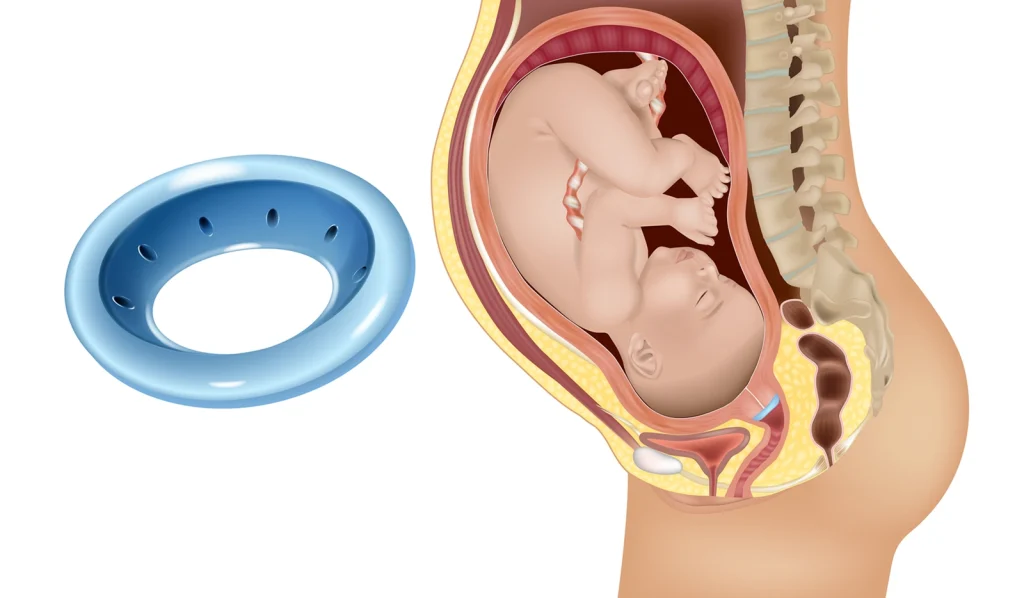 Pregnancy Specific Pessary – RYC®