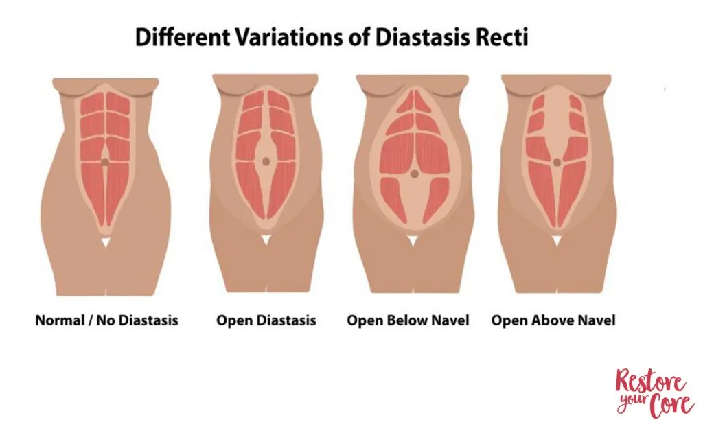 Variations of diastasis recti from left to right: Normal/No Diastasis, Open Diastasis, Open Below Navel, and Open Above Navel