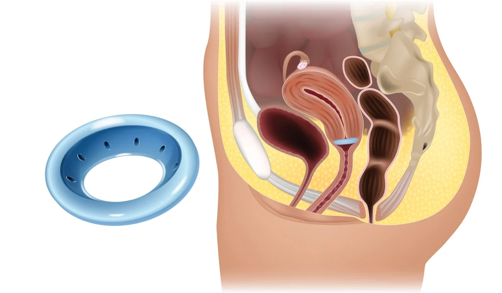 Pessary for prolapse – RYC®