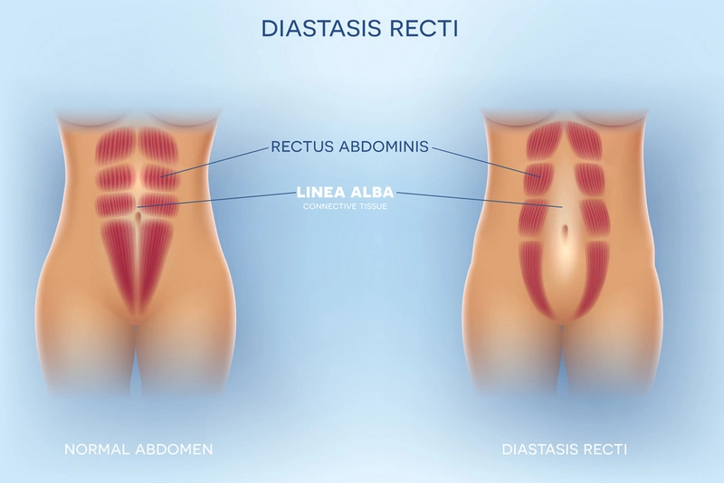 How Do I Heal Diastasis Recti Without Surgery? Why Thousands Trust Restore Your Core®