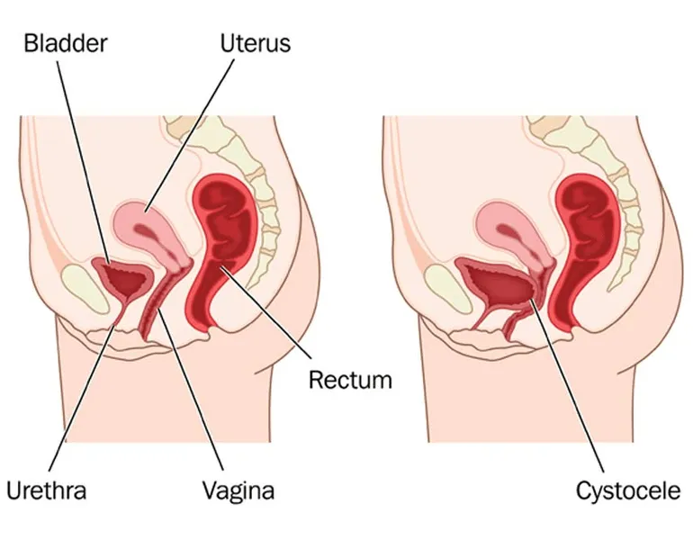 What Are the Most Effective Non-Surgical Treatments for Bladder Prolapse?
