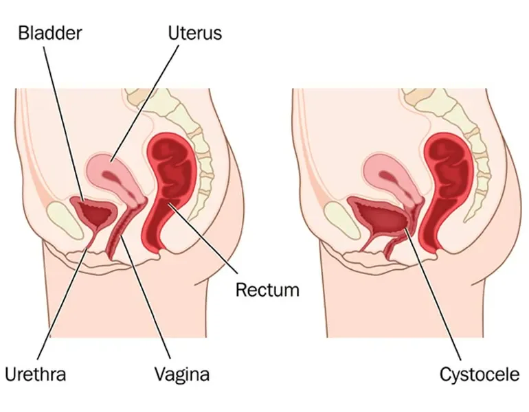 What Are the Most Effective Non-Surgical Treatments for Bladder Prolapse?