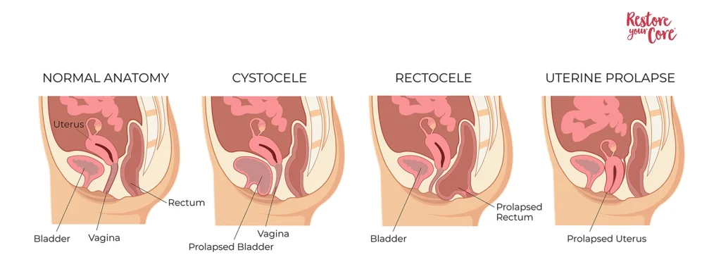Types of pelvic organ prolapse (left to right): Normal, cystocoele, uterine prolapse, rectocoele, enterocele