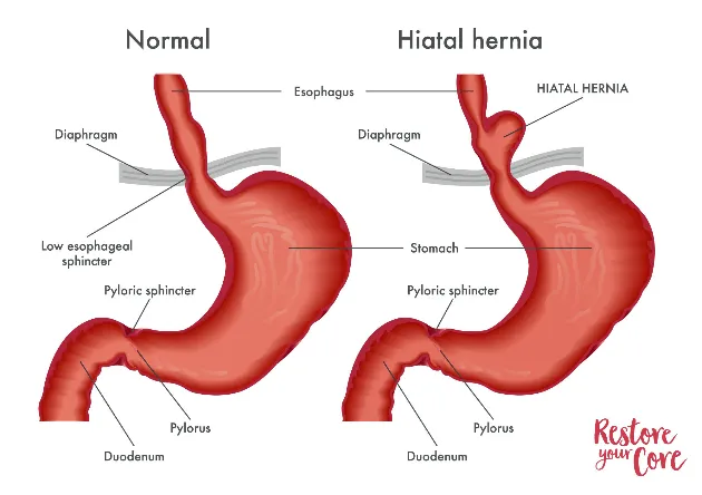 types of hernia