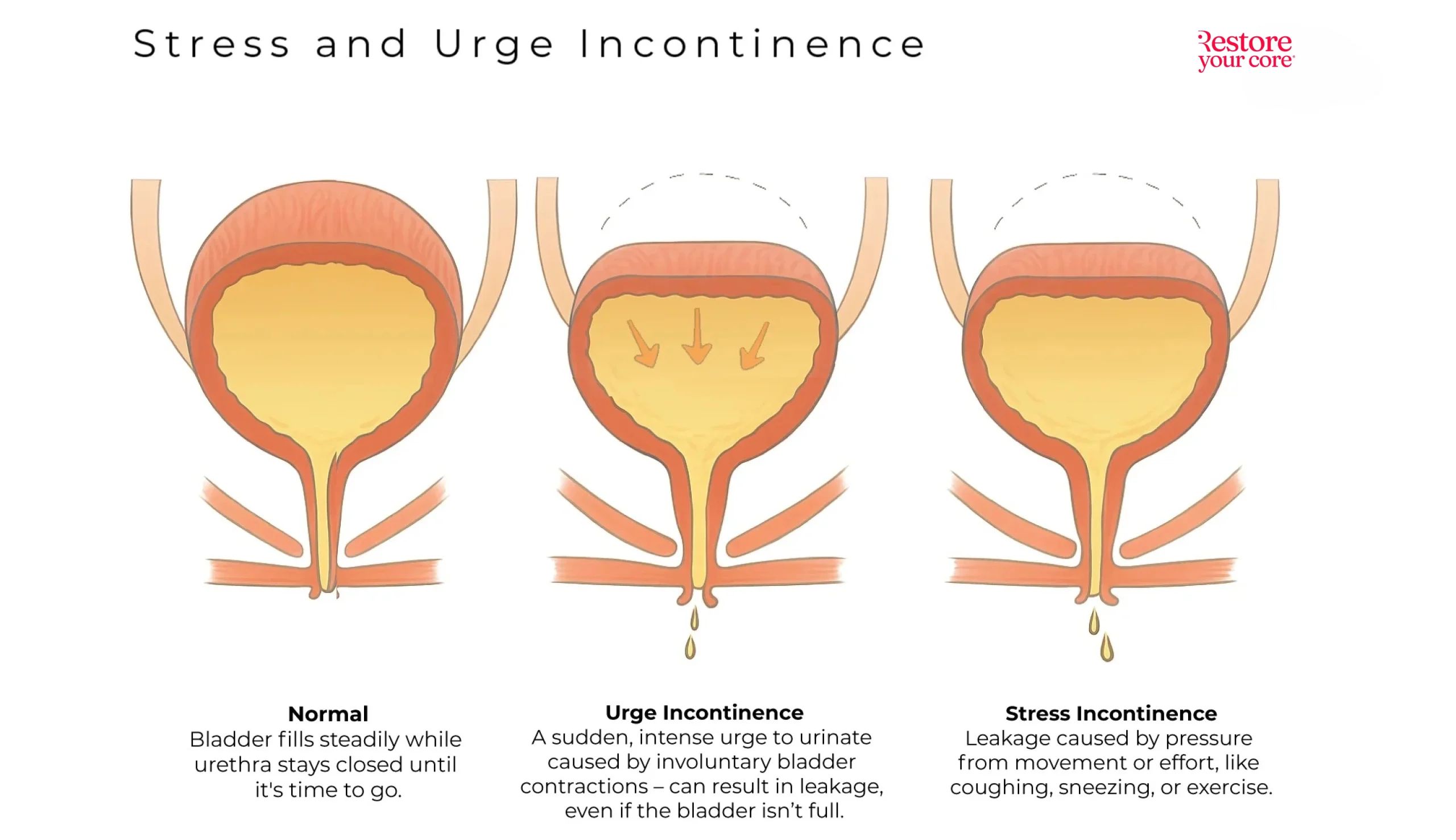 Stress and Urgency Incontinence – RYC®