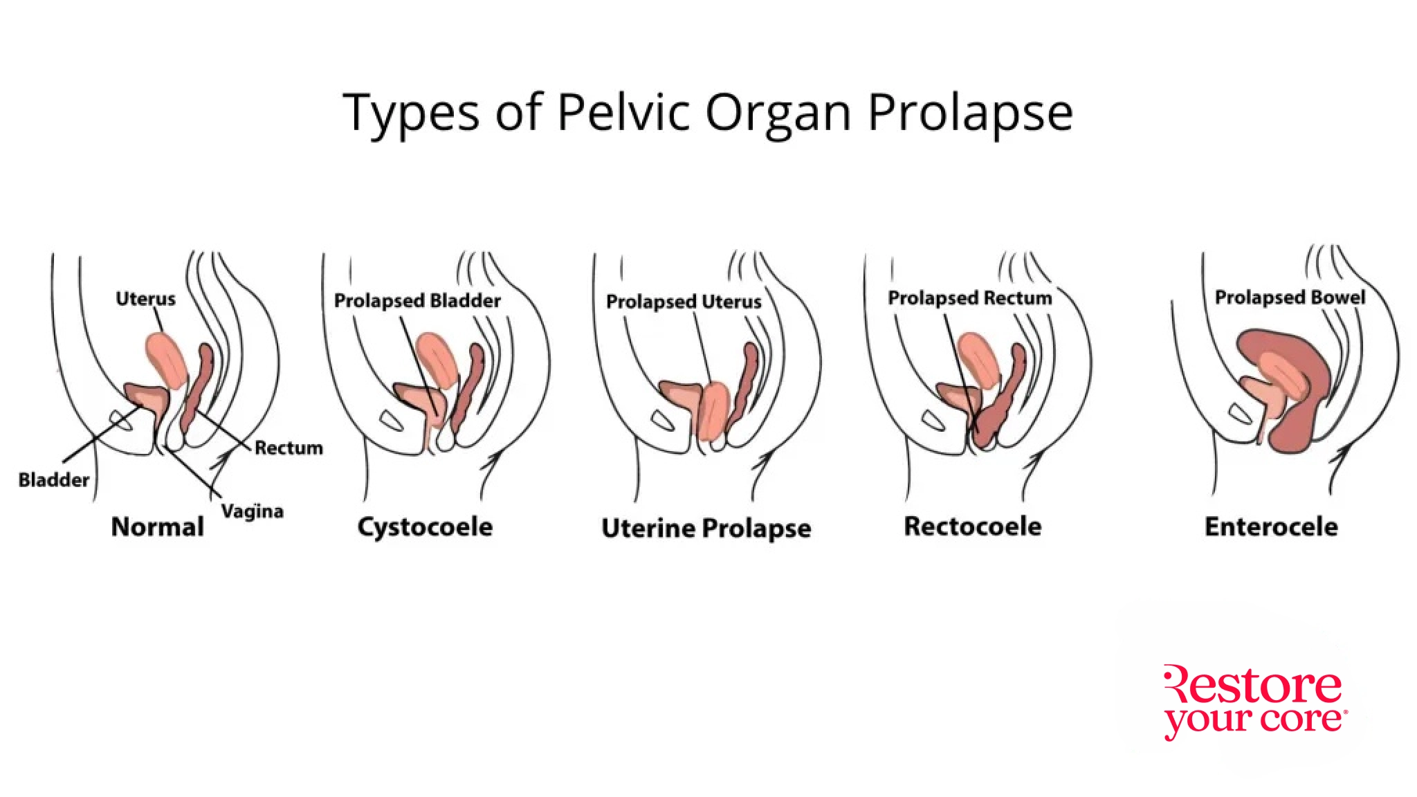 Understanding Prolapse After Childbirth