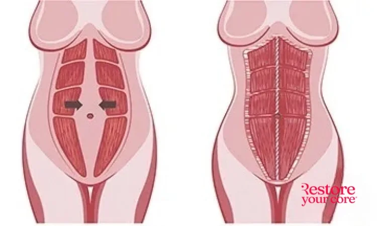Diastasis Recti Surgery | Procedure Overview | Will You Need It?