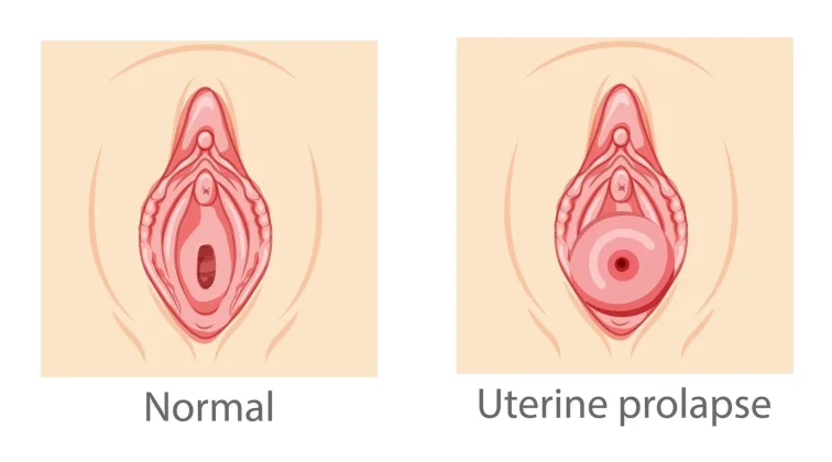 Can You Have Intercourse With Prolapsed Uterus?
