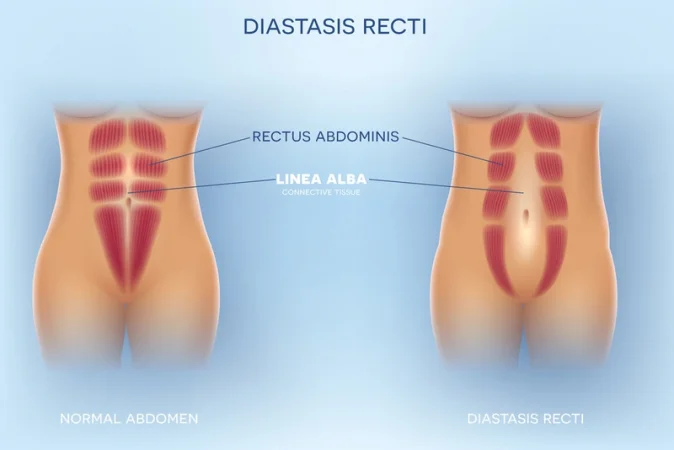 How to Fix Diastasis Recti Years Later: A Comprehensive Guide for Long-Term Healing