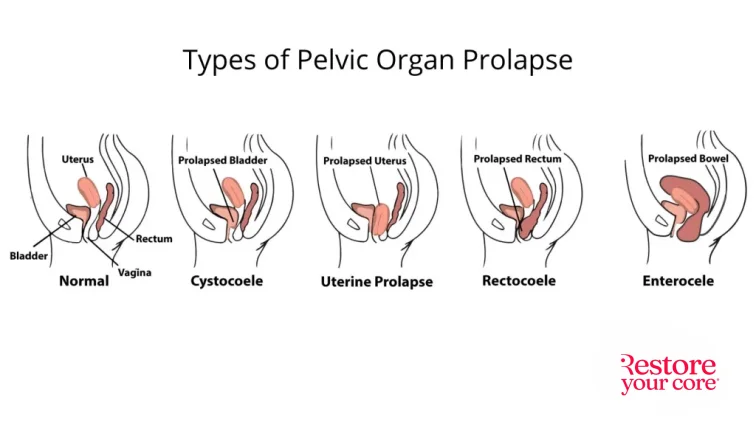 Understanding Prolapse After Childbirth
